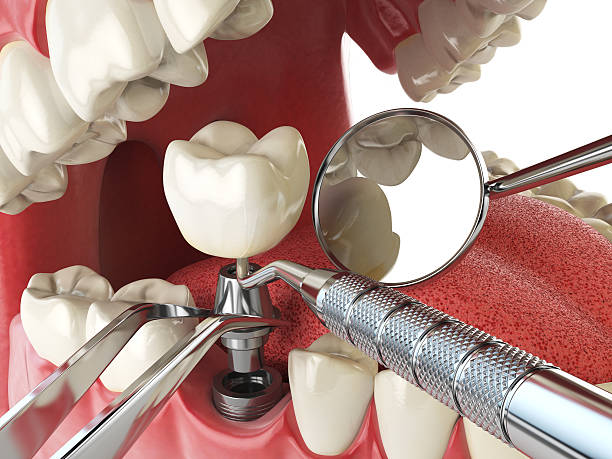 Best Emergency Tooth Extraction in Waverly, NY